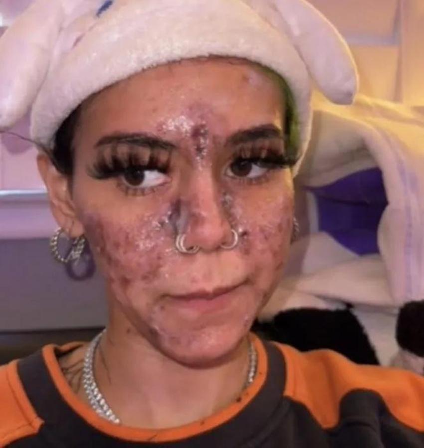 Evde yüz maskesi yaptı, yüzünü kaybetti! Bu ürünleri çöpe atın: Plastik cerrahlar kesin uyardı!