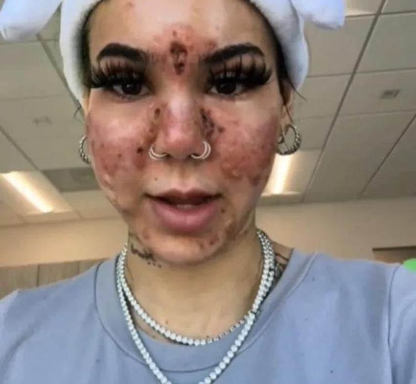 Evde yüz maskesi yaptı, yüzünü kaybetti! Bu ürünleri çöpe atın: Plastik cerrahlar kesin uyardı!