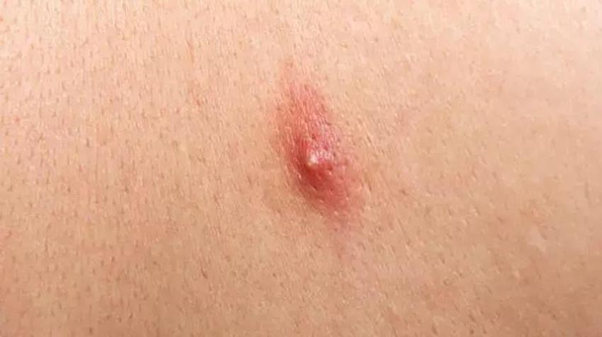 Omuz ve sırttaki sivilcelere sürünce etkisi kat kat artıyor; askılı giymek dert olmaktan çıkıyor! su bazlı olursa kesin çözüm sunuyor