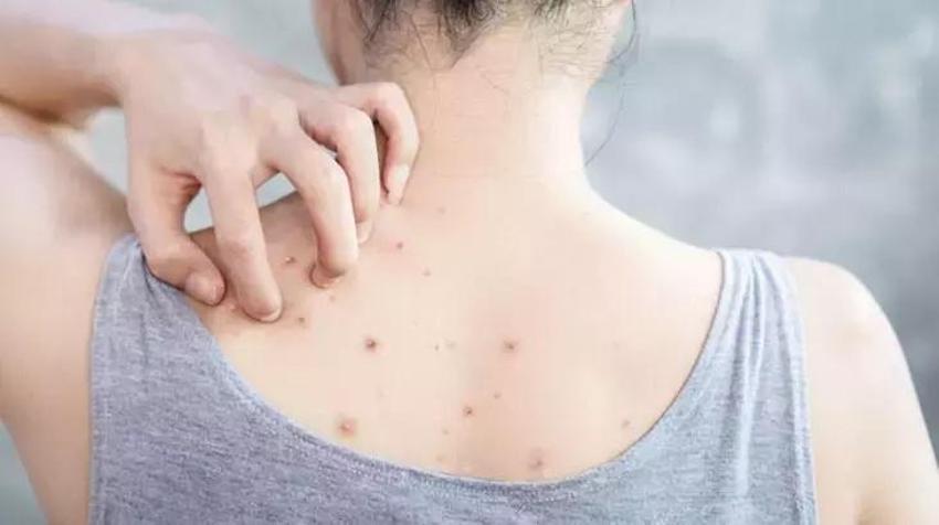 Omuz ve sırttaki sivilcelere sürünce etkisi kat kat artıyor; askılı giymek dert olmaktan çıkıyor! su bazlı olursa kesin çözüm sunuyor