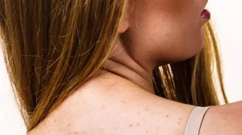 Omuz ve sırttaki sivilcelere sürünce etkisi kat kat artıyor; askılı giymek dert olmaktan çıkıyor! su bazlı olursa kesin çözüm sunuyor