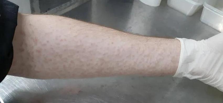 Herkes sivrisinekten kaçar ama bir doktor ısırmasına izin veriyor! Sivrisinekleri koluyola besliyor! Nedenini şöyle açıkladı!
