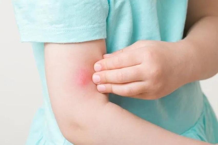 Herkes sivrisinekten kaçar ama bir doktor ısırmasına izin veriyor! Sivrisinekleri koluyola besliyor! Nedenini şöyle açıkladı!