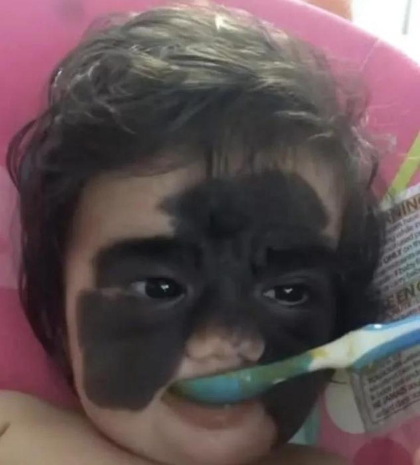 Yüzündeki leke yüzünden lanetli deniyordu! Küçük kızın şimdiki haline bir bakın!