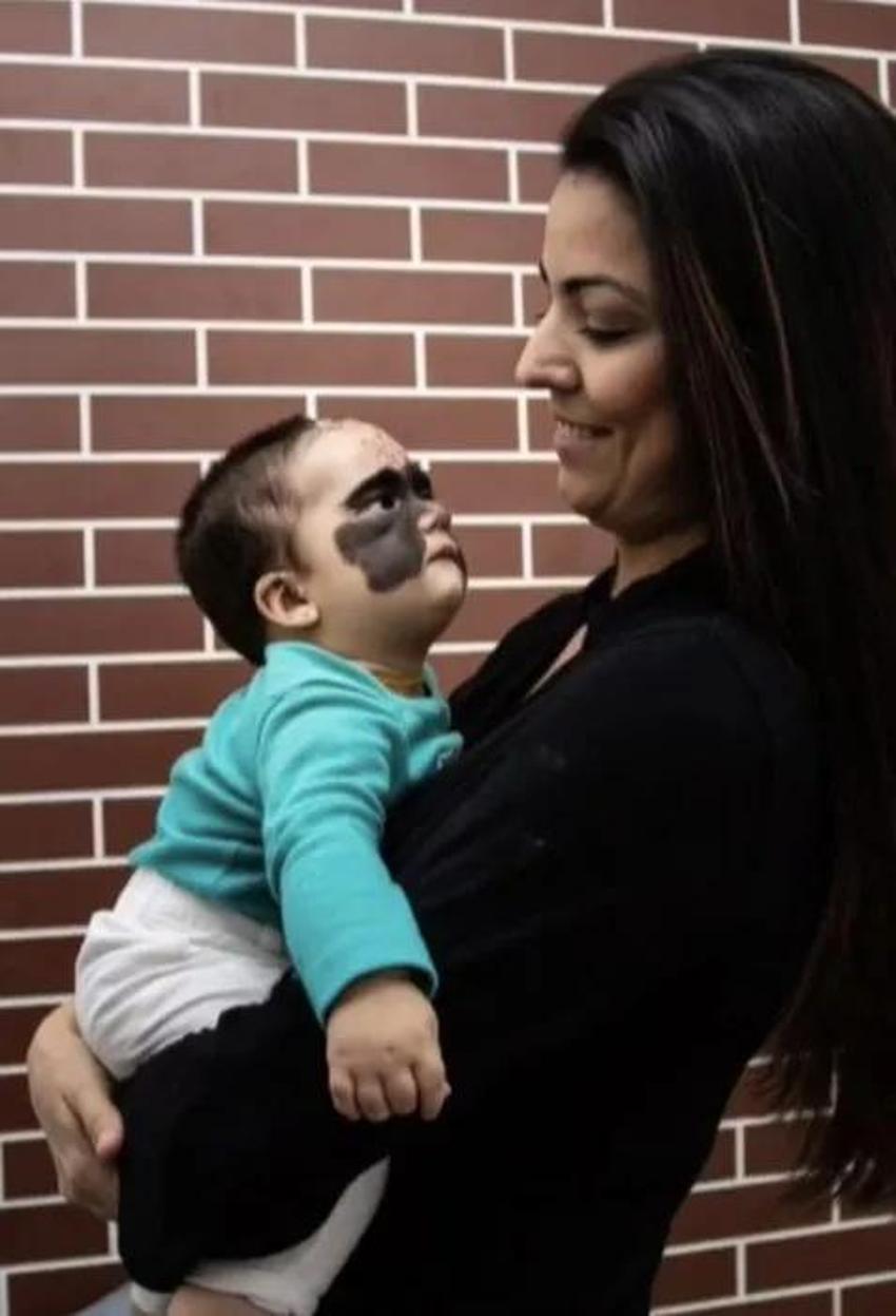 Yüzündeki leke yüzünden lanetli deniyordu! Küçük kızın şimdiki haline bir bakın!