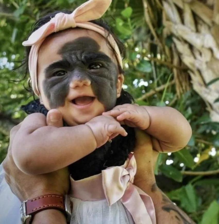 Yüzündeki leke yüzünden lanetli deniyordu! Küçük kızın şimdiki haline bir bakın!