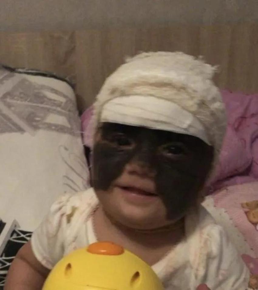 Yüzündeki leke yüzünden lanetli deniyordu! Küçük kızın şimdiki haline bir bakın!