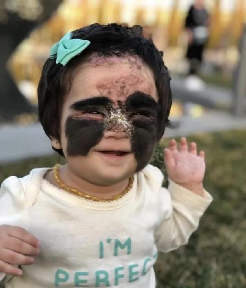 Yüzündeki leke yüzünden lanetli deniyordu! Küçük kızın şimdiki haline bir bakın!