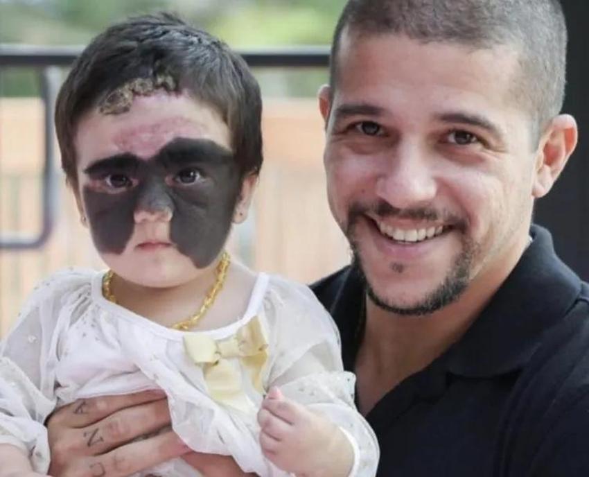 Yüzündeki leke yüzünden lanetli deniyordu! Küçük kızın şimdiki haline bir bakın!