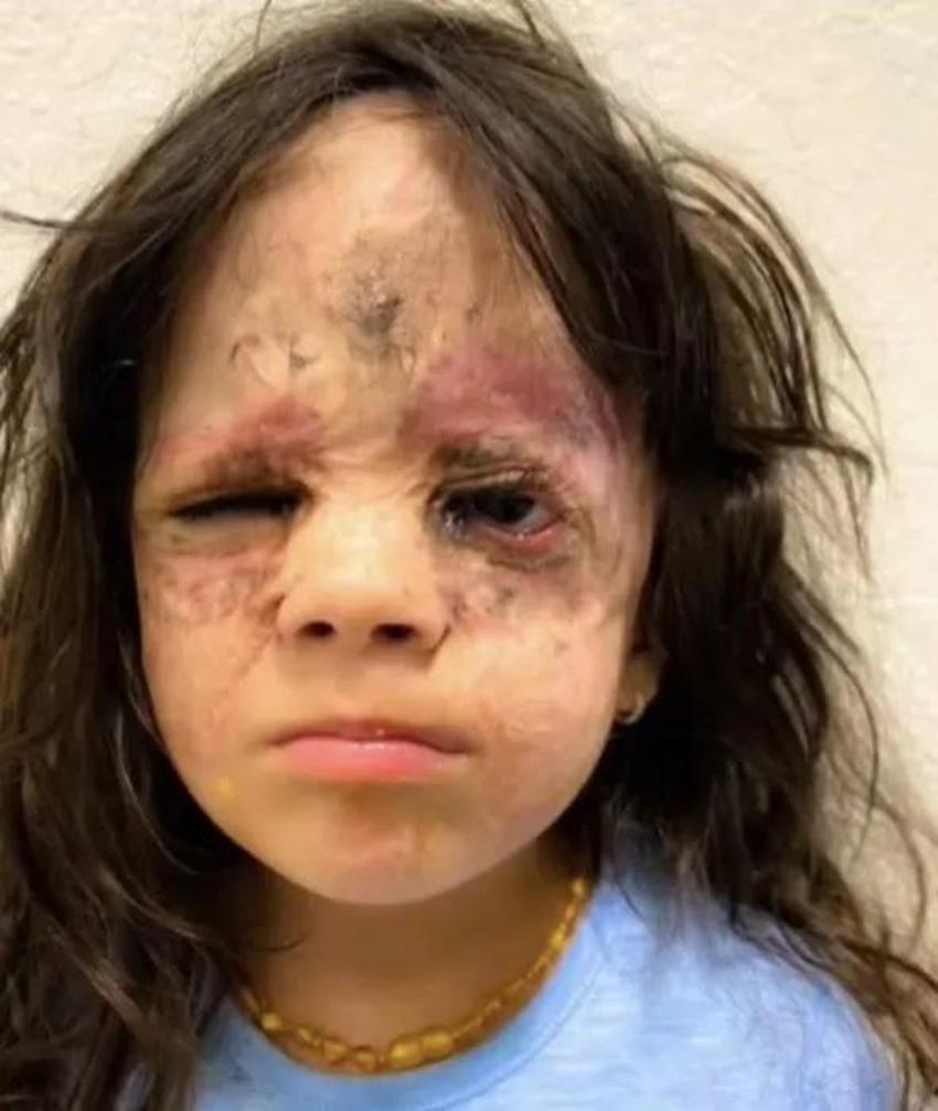 Yüzündeki leke yüzünden lanetli deniyordu! Küçük kızın şimdiki haline bir bakın!