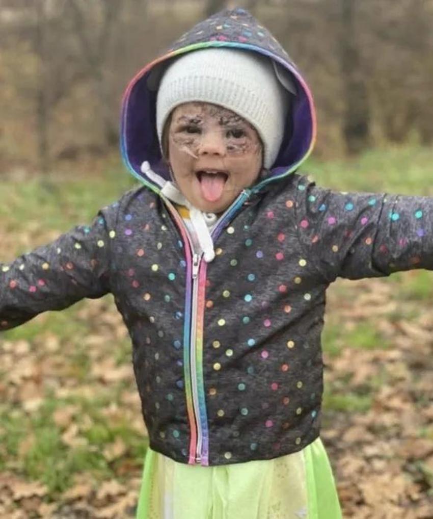 Yüzündeki leke yüzünden lanetli deniyordu! Küçük kızın şimdiki haline bir bakın!