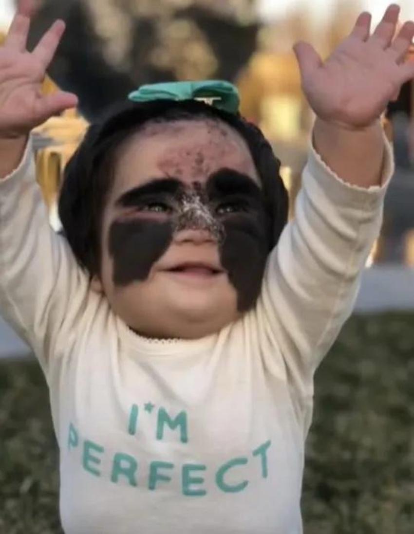 Yüzündeki leke yüzünden lanetli deniyordu! Küçük kızın şimdiki haline bir bakın!