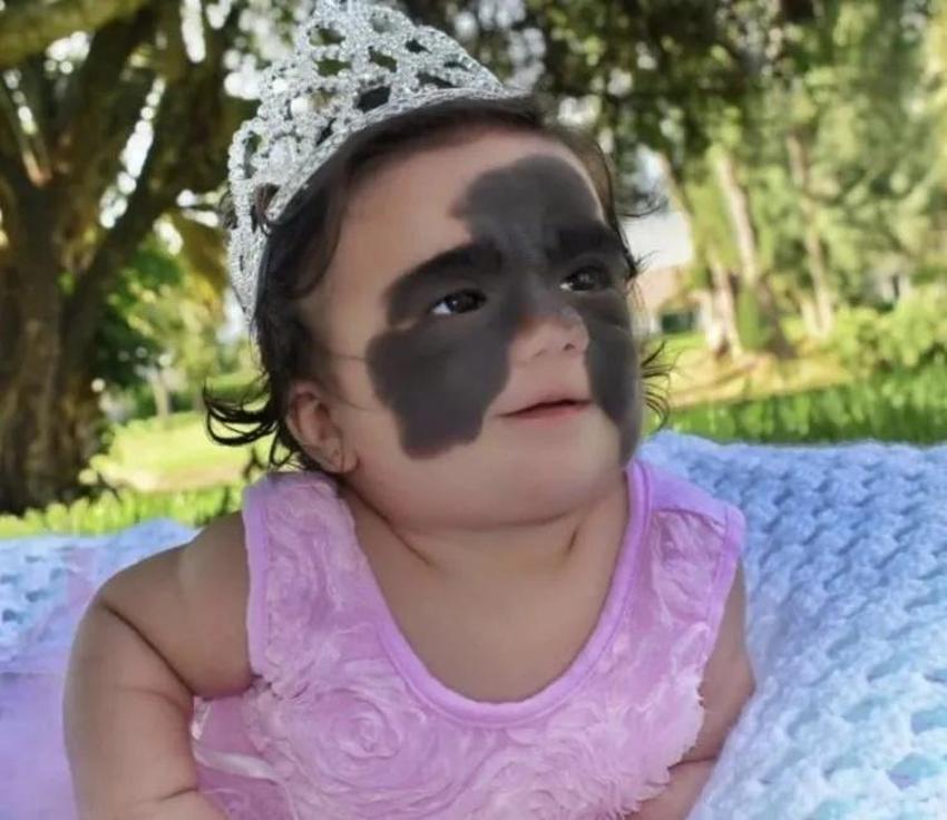 Yüzündeki leke yüzünden lanetli deniyordu! Küçük kızın şimdiki haline bir bakın!