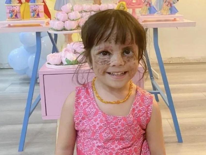 Yüzündeki leke yüzünden lanetli deniyordu! Küçük kızın şimdiki haline bir bakın!