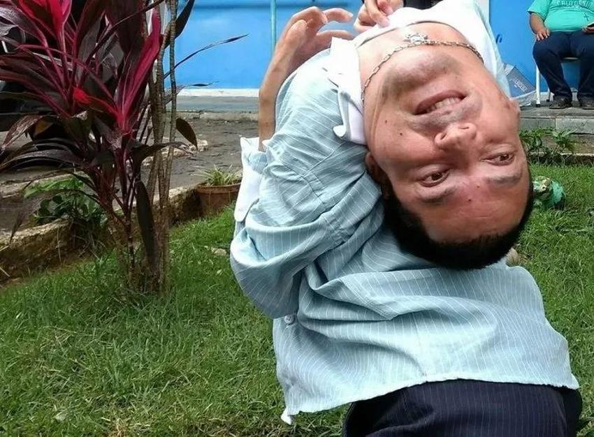 Baş aşağı doğdu tüm dünyaya ders oldu! 48 yaşındaki adam ameliyat olmayı neden reddettiğini açıkladı