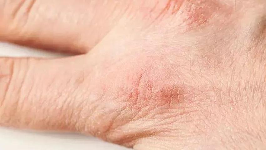 Ev yapımı nemlendirici: Bu yağ ellerde kuruluğu pamuk gibi yapıyor!
