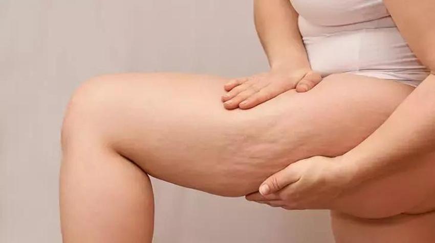 Selülit düşmannı, kaymak gibi cildin sırrı! Kahve, şeker ve zeytinyağı kurtarıyor