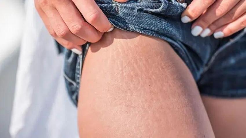 Selülit düşmannı, kaymak gibi cildin sırrı! Kahve, şeker ve zeytinyağı kurtarıyor