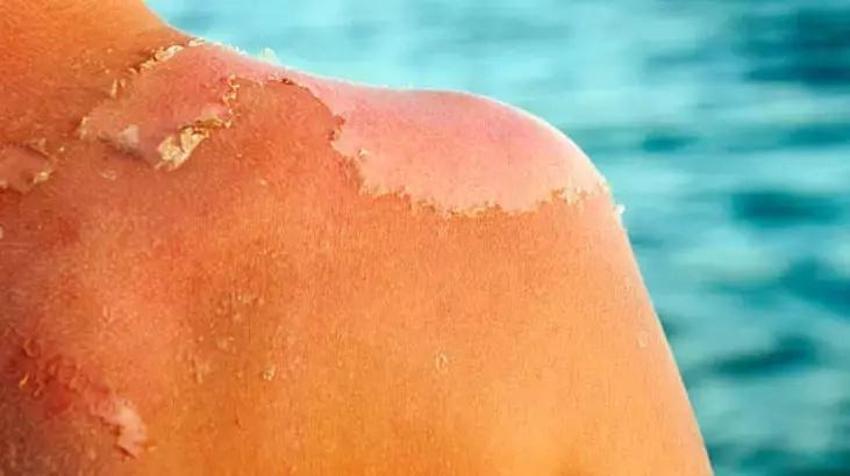 Cildiniz soyulmaya başladıysa bu yöntemi deneyin! Enfeksiyon riskini kat kat azaltıyor