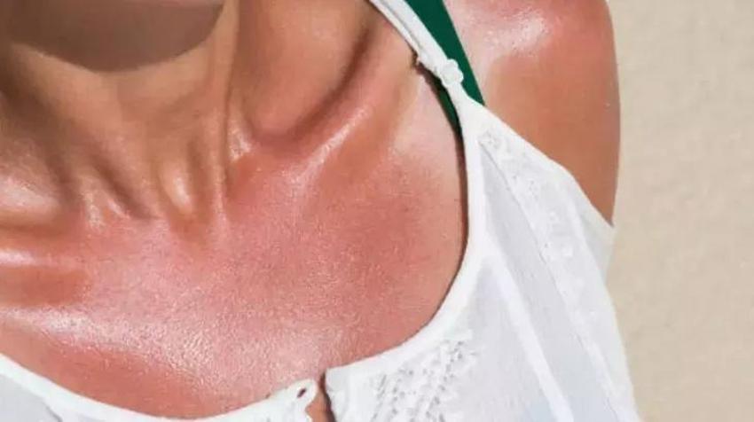 Cildiniz soyulmaya başladıysa bu yöntemi deneyin! Enfeksiyon riskini kat kat azaltıyor