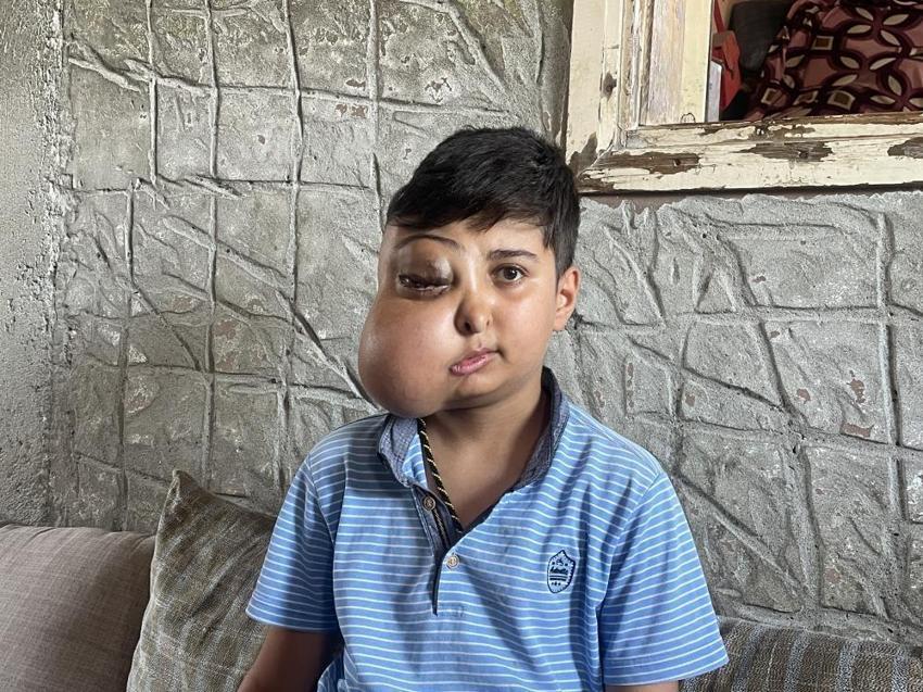 Hastalığı nedeniyle yüzünde kitle olan Enes'in sesi duyuldu: Ankara'da tedavisi başladı