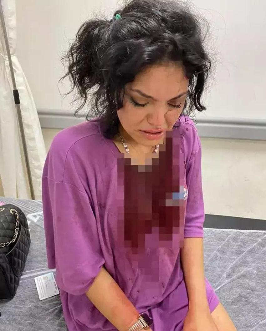 Topuklu ayakkabıyla başına vurulmuştu! Eslem Sena Nur yaşadıklarını anlattı