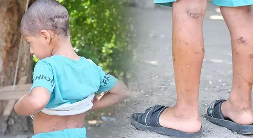 Adana'da sokak köpeklerinin saldırısına uğrayan 5 yaşındaki çocuktan iyi haber! Mahallesinde hala sokak köpekleri dolaşıyor