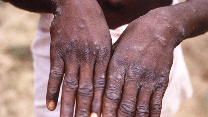 Hem hayvanlardan hem de insanlardan bulaşıyor! Afrika'da yayılmaya başlayan salgın için acil durum ilanı