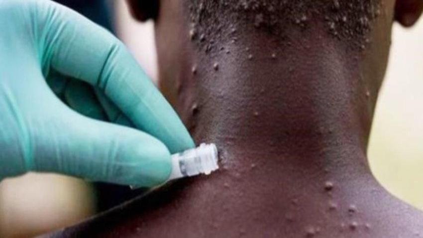 Maymun çiçeği korkusu tüm dünyayı sardı!  Mpox belirtileri neler? 'Maymun Çiçeği'nin anatomisi