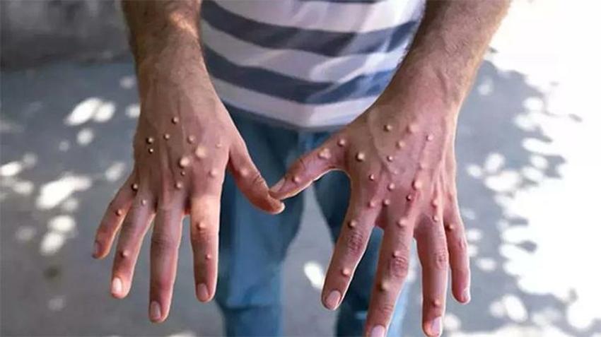 Maymun çiçeği korkusu tüm dünyayı sardı!  Mpox belirtileri neler? 'Maymun Çiçeği'nin anatomisi