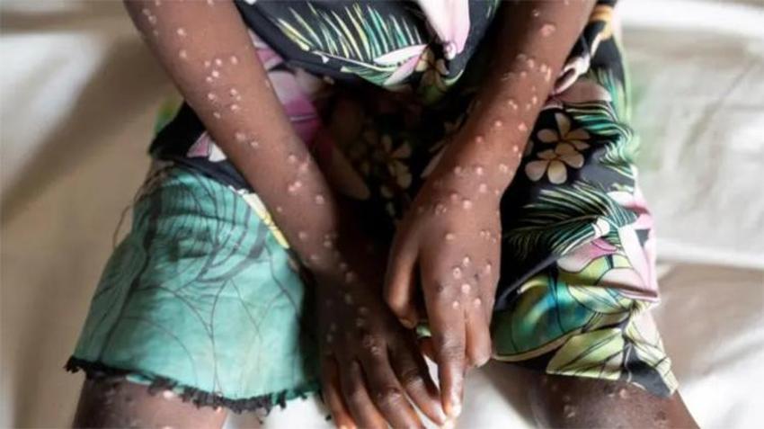 Maymun çiçeği korkusu tüm dünyayı sardı!  Mpox belirtileri neler? 'Maymun Çiçeği'nin anatomisi