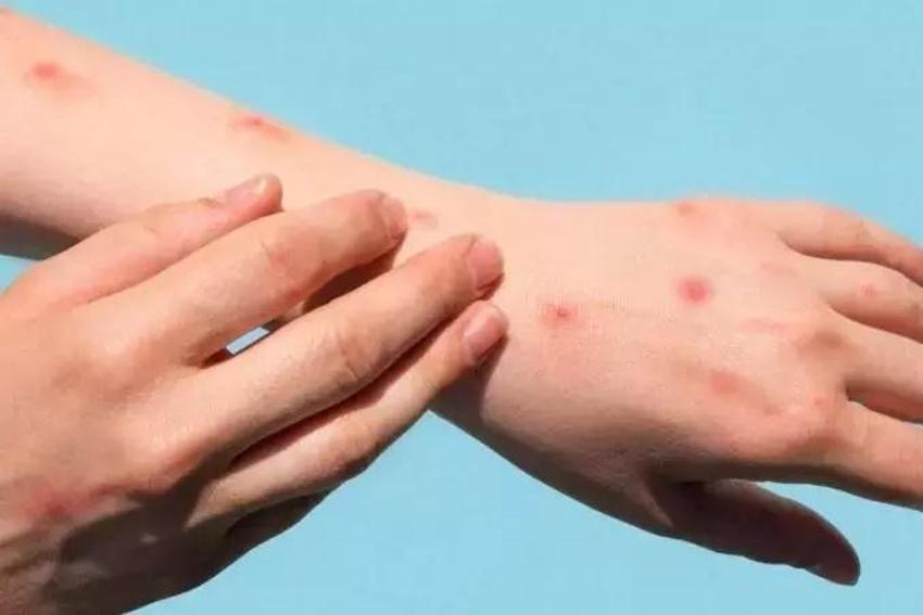 Maymun çiçeği korkusu tüm dünyayı sardı!  Mpox belirtileri neler? 'Maymun Çiçeği'nin anatomisi