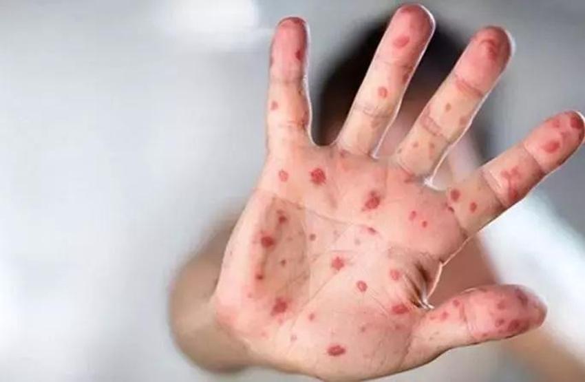 Maymun Çiçeği Hastalığı (mpox) nasıl bulaşır, ölümcül mü, belirtileri neler? Maymun Çiçeği Türkiye'de var mı?