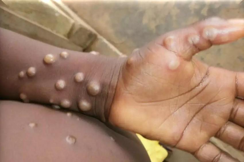 Maymun çiçeği korkusu tüm dünyayı sardı!  Mpox belirtileri neler? 'Maymun Çiçeği'nin anatomisi