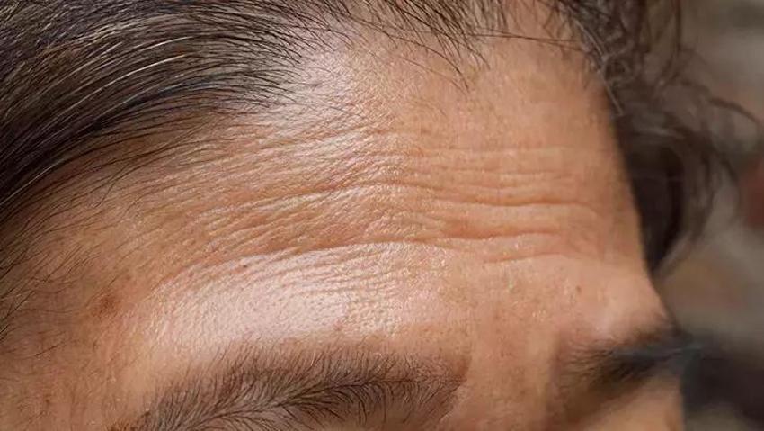 Cilt kırışıklığı uyukudayken geçiyor! Bu pozisyonda uyumak etkisini gösteriyor