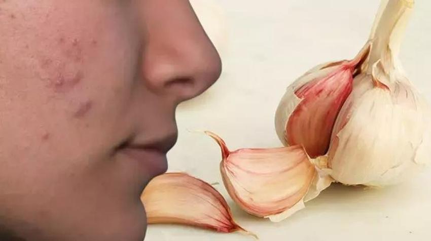 TikTok'ta yayıldı kimse durduramıyor! Çiğ sarımsak sivilceye iyi gelir mi?