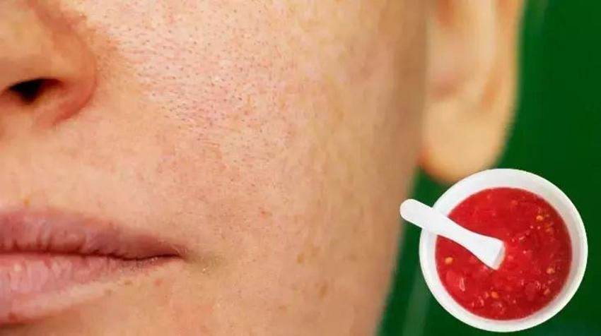 Siyah noktaları dibinden kurutuyor! Evde hızlıca hazırlanan karışım
