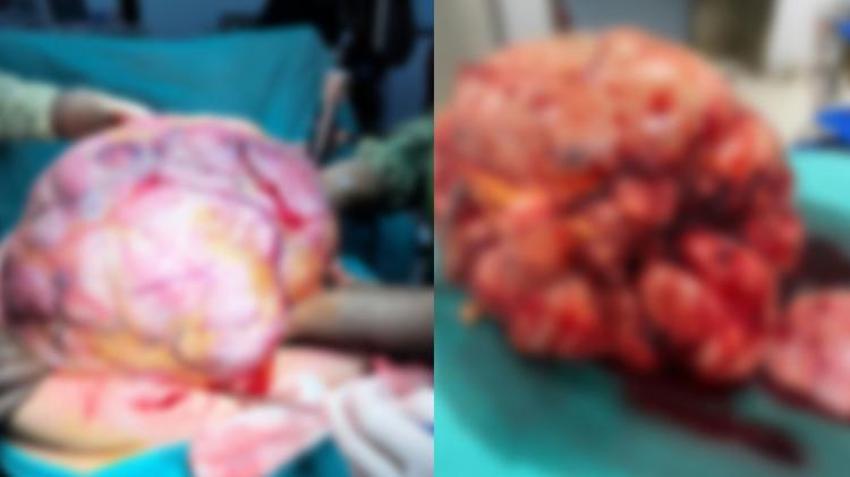 Trabzon'da karın ağrısı şikayetiyle doktora giden adamın karnında tümör bulundu