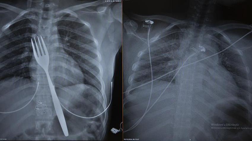 Aydın'da sıra dışı vaka! Doktorlar bile inanamadı, röntgende gerçek ortaya çıktı