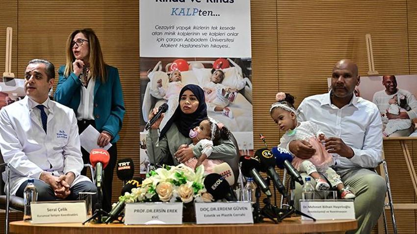 Cezayirli yapışık ikizler İstanbul'da ameliyatla ayrıldı