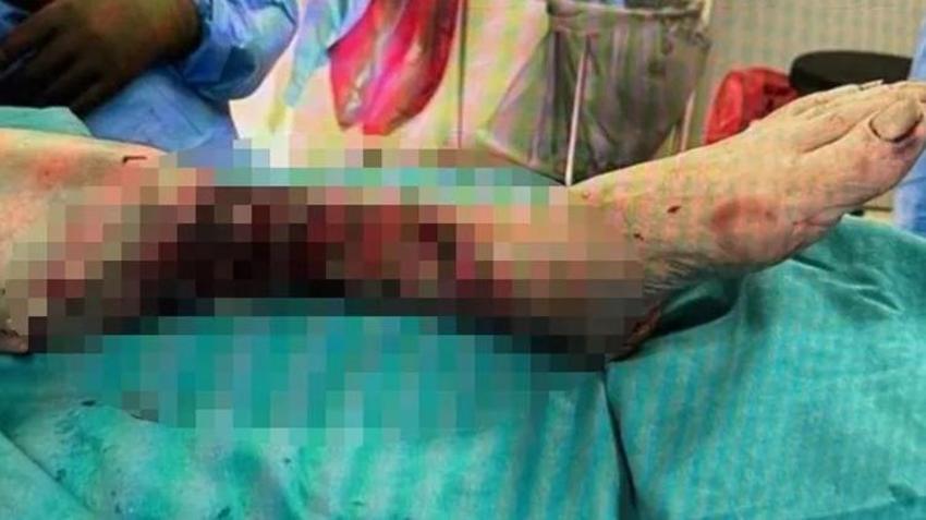 Pitbull saldırısında bacağını kaybetmişti! Savcı köpeğin sahibine ve bakıcısına hapis cezası istedi