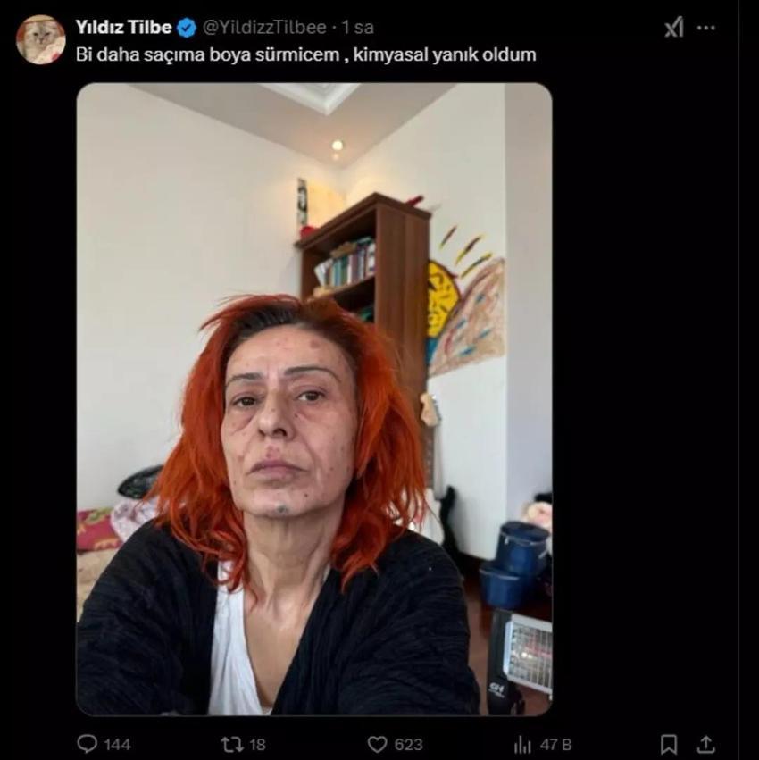 Yıldız Tilbe'nin yüzü yandı! Son hali hayranlarını korkuttu