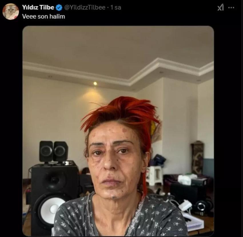 Yıldız Tilbe'nin yüzü yandı! Son hali hayranlarını korkuttu