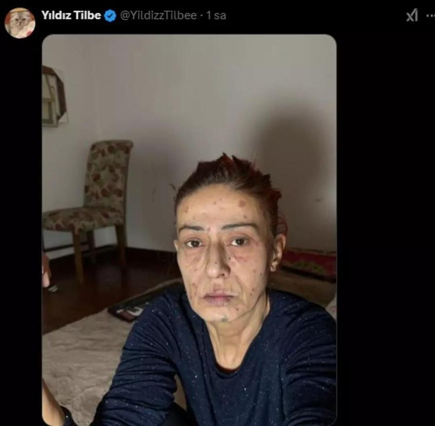 Yıldız Tilbe'nin yüzü yandı! Son hali hayranlarını korkuttu