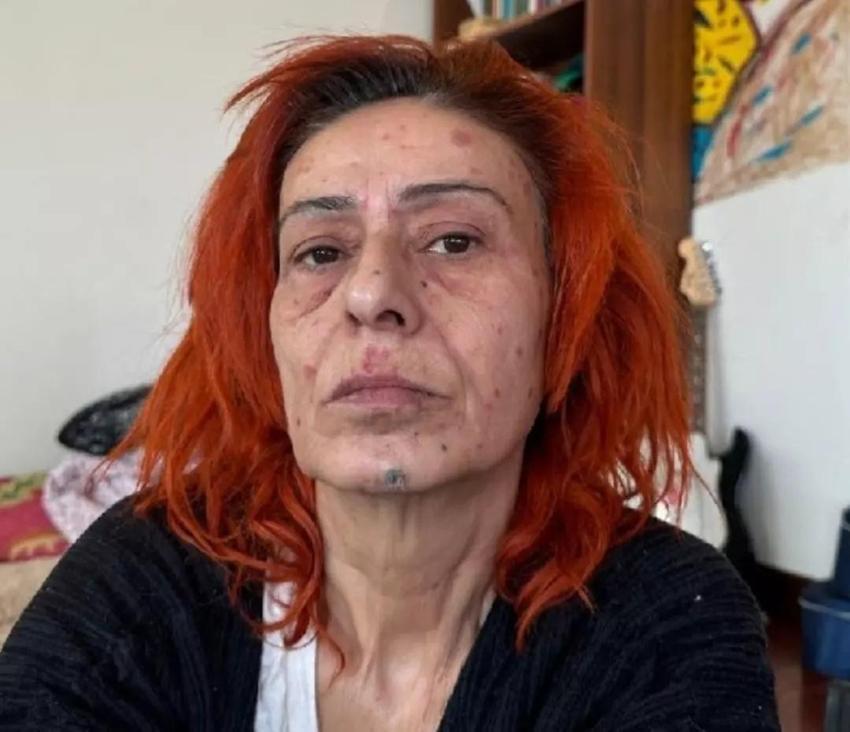 Yüzü yanmıştı! Yıldız Tilbe son halini sahnede gösterdi
