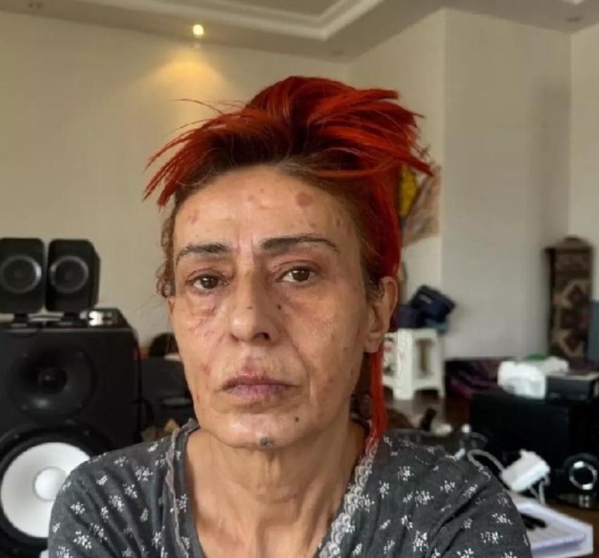 Yüzü yanmıştı! Yıldız Tilbe son halini sahnede gösterdi
