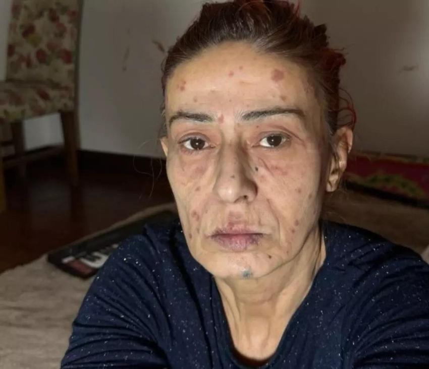 Yüzü yanmıştı! Yıldız Tilbe son halini sahnede gösterdi

