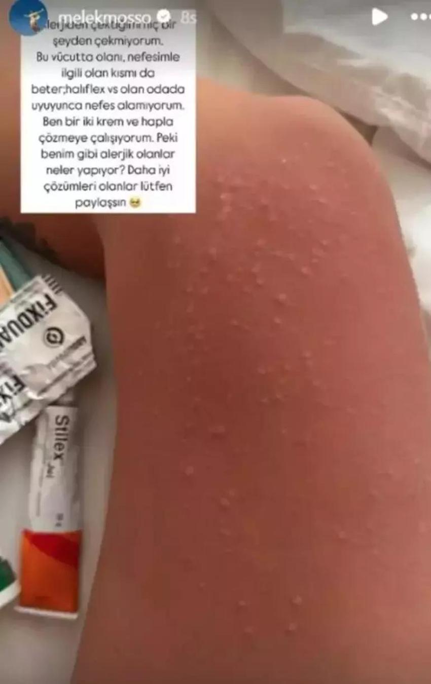 Melek Mosso tatilde hastanelik oldu! Paylaşımı korkuttu