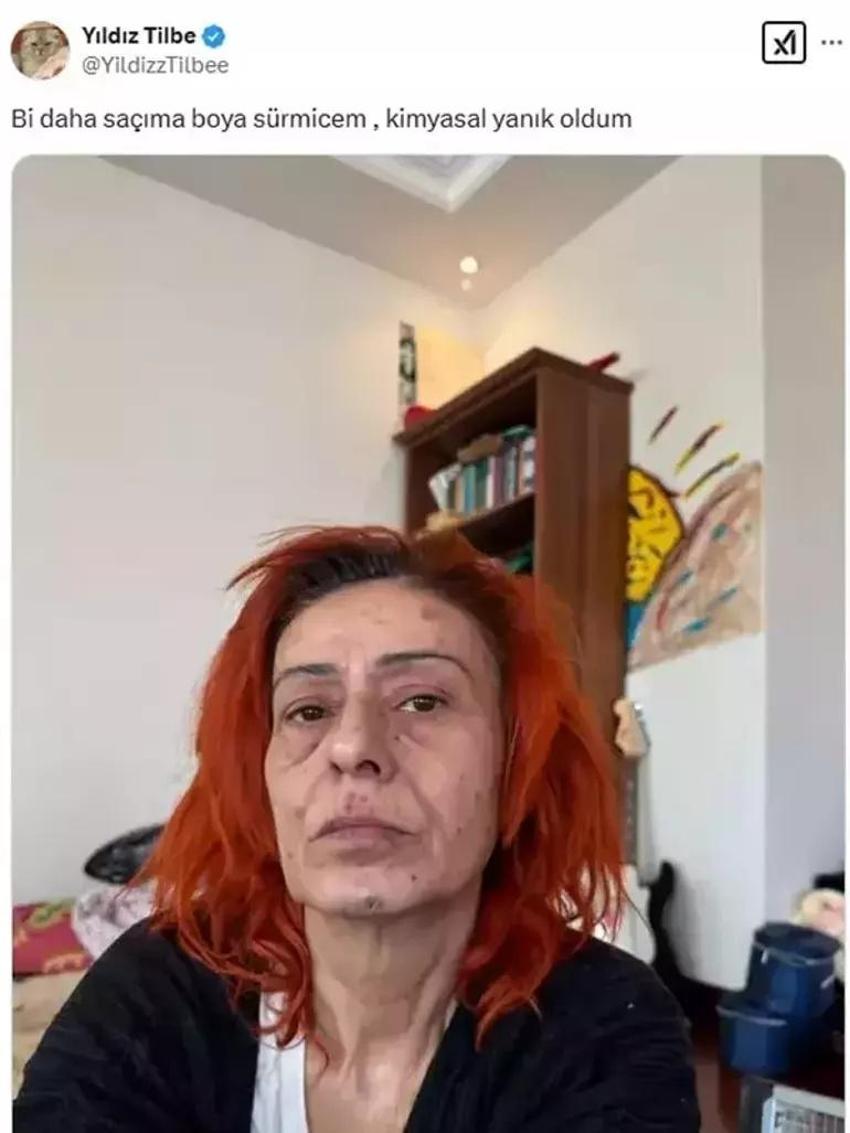 Saç boyasından yüzü yanmıştı! Yıldız Tilbe günler sonra görüldü
