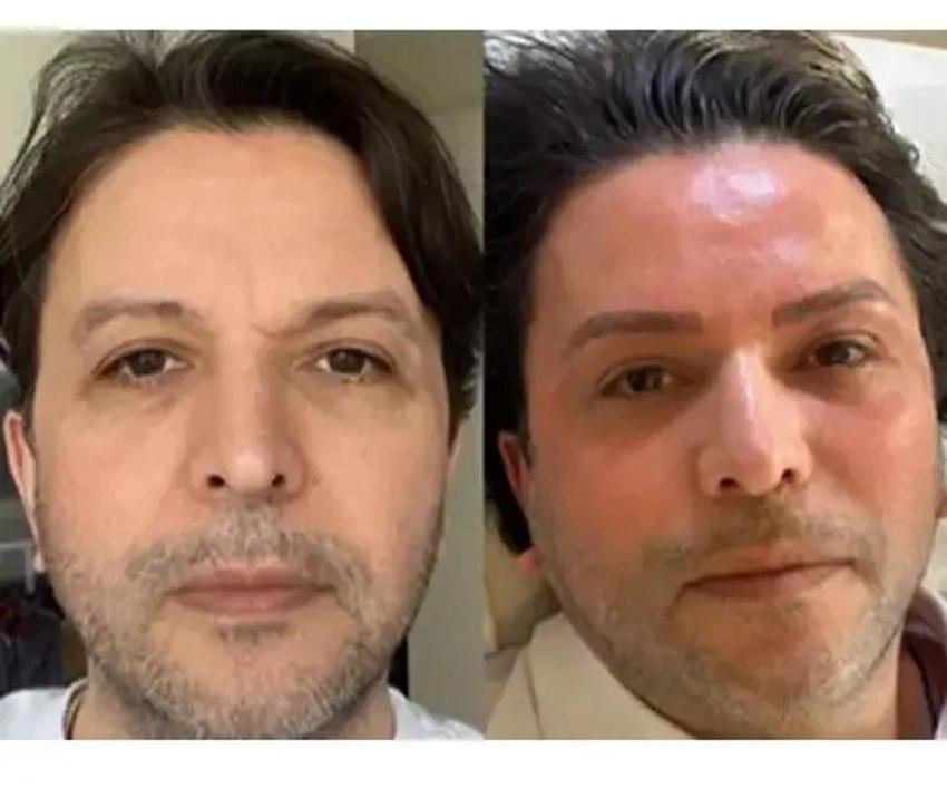 Nihat Doğan da estetikli furyasına katıldı! İşte son hali